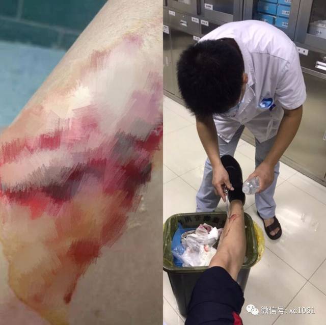 (图为医生在清理戴玮同志腿伤)