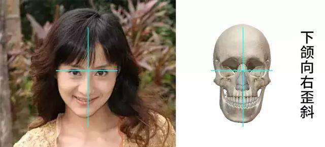 正美体态:脸歪还可能与这个原因有关,你注意到了吗?