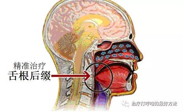 肖忠贤:一种非常可怕的疾病——睡眠舌根后缀