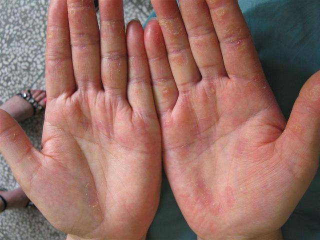 手部湿疹的病因,分类及其治疗