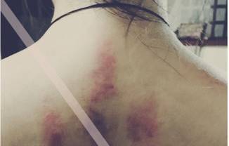 秋季刮刮痧轻松活过88刮痧后的痧印分析知道点非常必要
