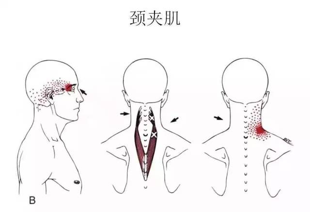 后颈肌群(posterior cervical muscles: multifundi, semispinalis)