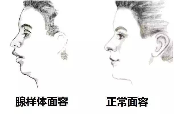 "腺样体面容".