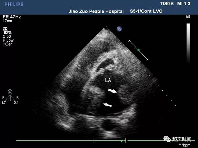 二尖瓣狭窄:你想知道的超声知识点都在