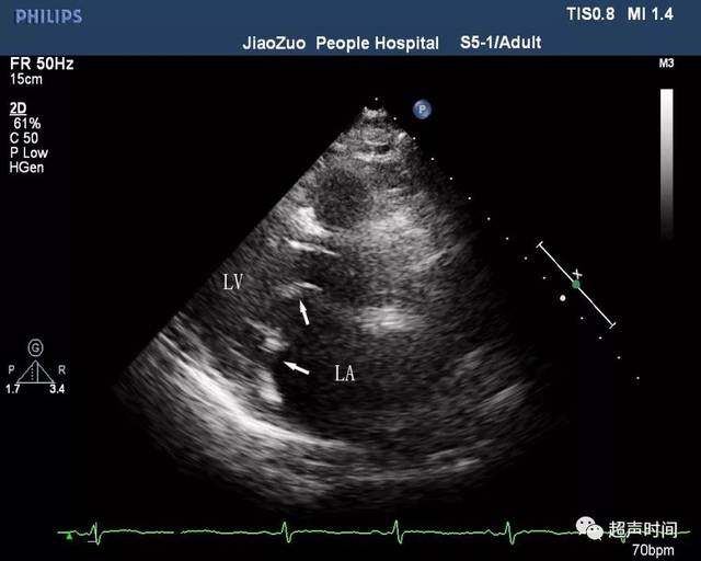 二尖瓣狭窄:你想知道的超声知识点都在