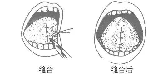 舌系带过短要不要剪?先对照看看宝宝有无这4种连带表现