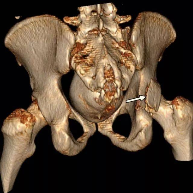 图13b,ct三维重建显示后壁骨折(箭头)