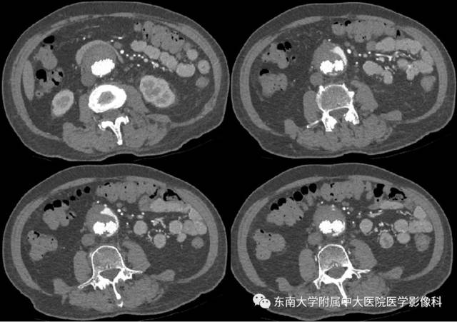 腹主动脉瘤腔内修补及术后随访影像评估