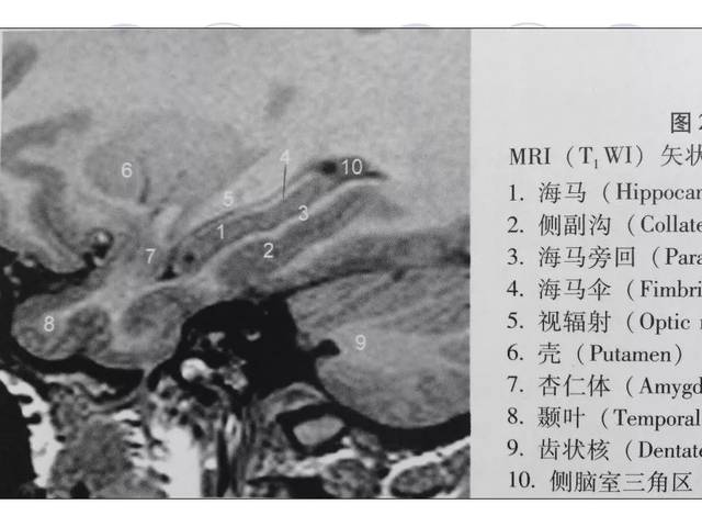 海马解剖结构与mri的诊断应用丨影像天地