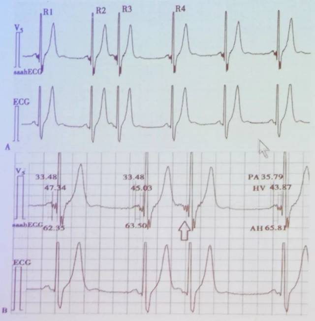 张树龙:尼沙赫心电图--亦真亦幻,如何求索?|