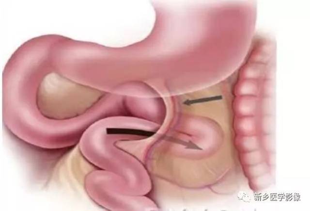 ct可更清楚显示疝入肠袢的位置,可位于treitz韧带左侧,胃与胰腺之间