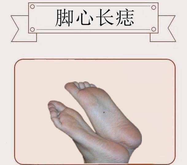 脚心长痣