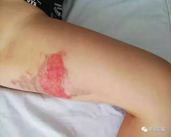 男孩大腿被烫伤 受访者供图