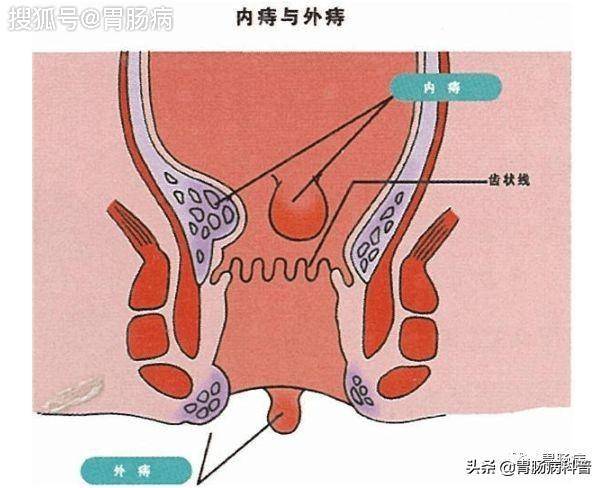 什么是痔疮?