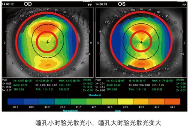 如图1,角膜地形图表现为周边的角膜散光状况,而中央部分角膜散光不大