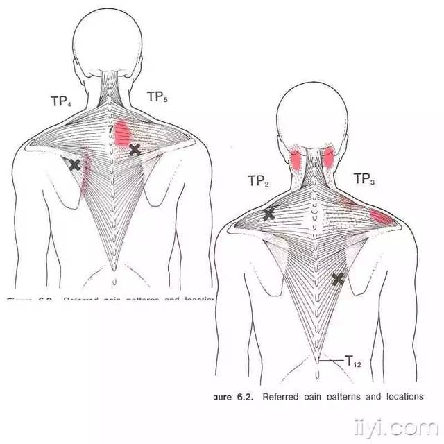 肌筋膜触发点详细图谱——建议收藏