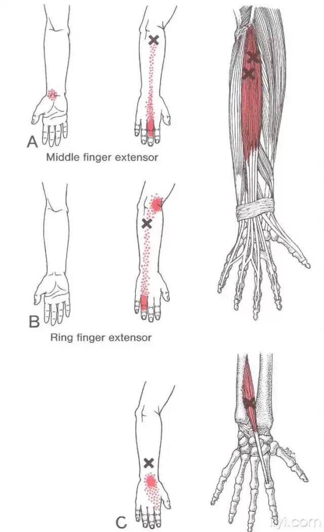 肌筋膜触发点详细图谱——建议收藏