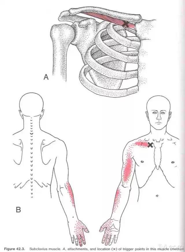 肌筋膜触发点详细图谱—建议收藏