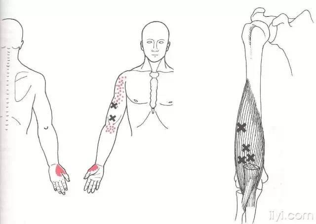 肌筋膜触发点详细图谱——建议收藏