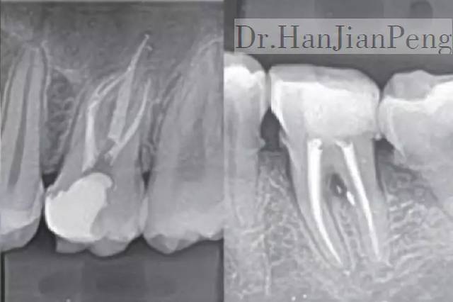 图16 不同磨牙根管充填后可见的侧支根管