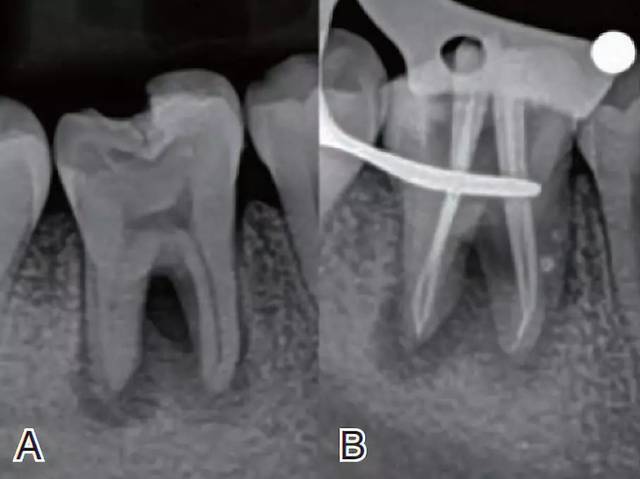 侧支根管的充填经验分享丨年轻医生临床分享会