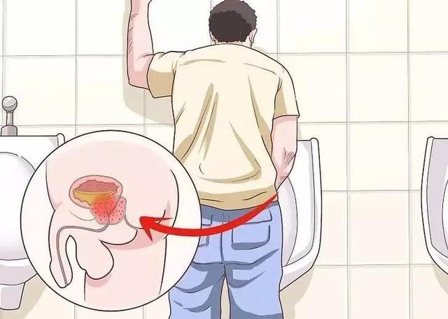 原创怀疑自己前列腺炎?丁丁教你分辨什么类型!