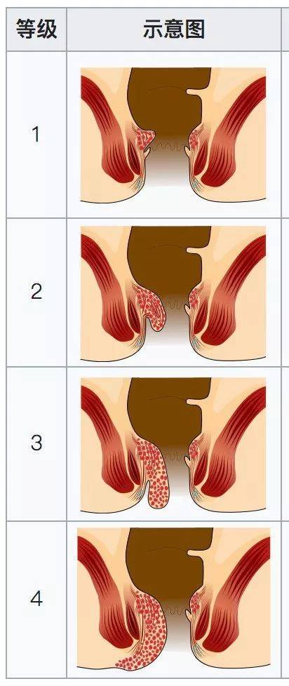 长了痔疮的0,是不是只能含泪做1?