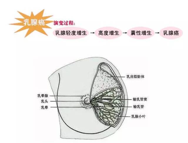 乳腺增生到乳腺癌只需三步