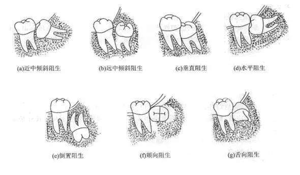 智齿|阻生智齿为啥要拔?看完这些就知道