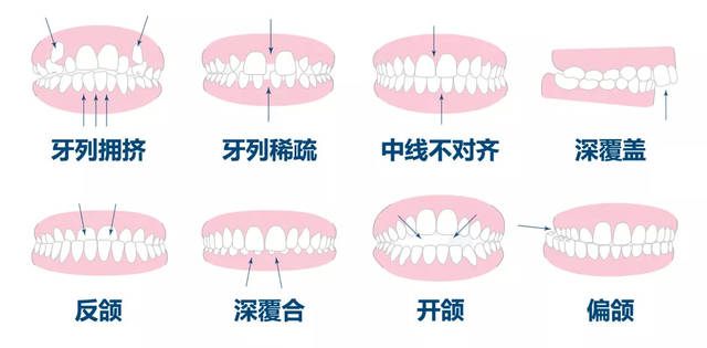 当然,以上的两种矫正方式都是针对牙性深覆合,如果是骨性的情况,则