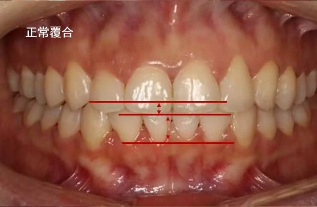 深覆盖 vs 深覆合,这一篇看完就都明白了!