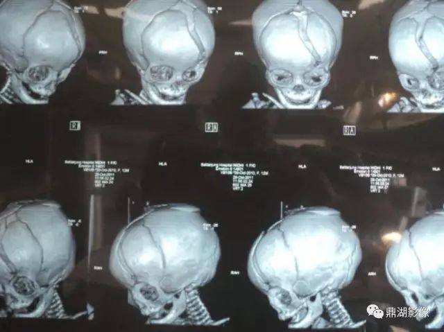 少见的颅骨生长性骨折:内附影像及手术图片