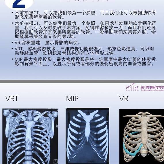 微调篇:肋软骨隆鼻与耳软骨隆鼻,你站哪一边?(肋软骨篇)