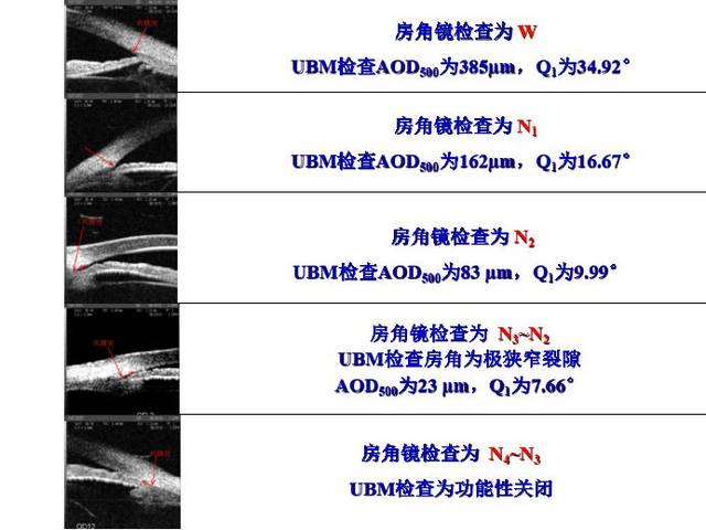 ubm结合了高频超声(50mhz~100mhz)和计算机图象处理技术,可在活体显示