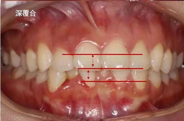 牙齿矫正的人必须要明白,深覆盖 vs 深覆合的区别!