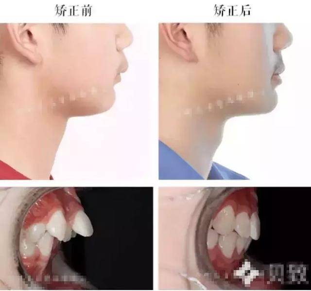 牙齿矫正的人必须要明白,深覆盖 vs 深覆合的区别!