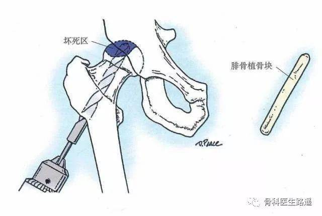 2)中期(arco2-3b期):保髋手术