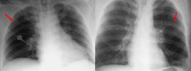 上) ◆右心室肥大 ◆mitral insufficiency所致全心衰伴肺水肿 烧瓶样