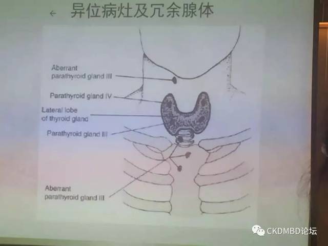 由于甲状旁腺每个人生长数目不固定,且有的位置不一,甚至会比较隐蔽