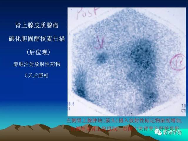 库欣综合征的诊断和治疗——皮质醇增多症(hypercortisolism)