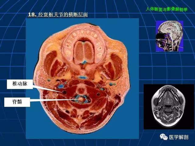 超赞!颅脑大体及磁共振断层解剖(轴位)