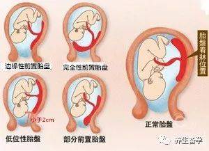 胎盘位置低怎么办?