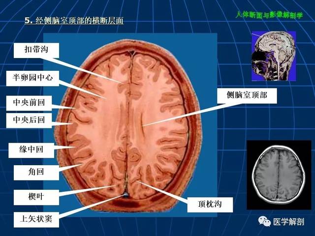 超赞!颅脑大体及磁共振断层解剖(轴位)