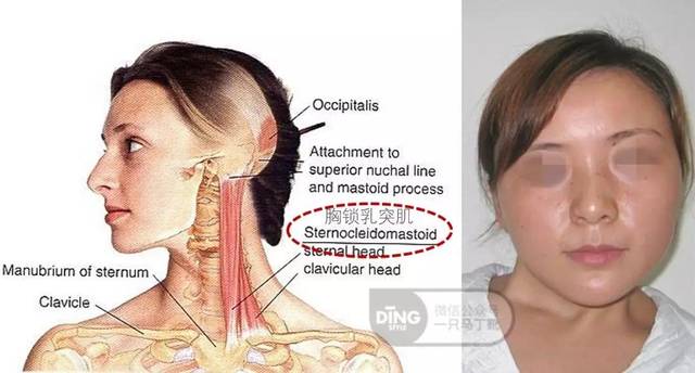 原因在于长在脖子两侧的"胸锁乳突肌",其中一边出现肌肉挛缩,就会