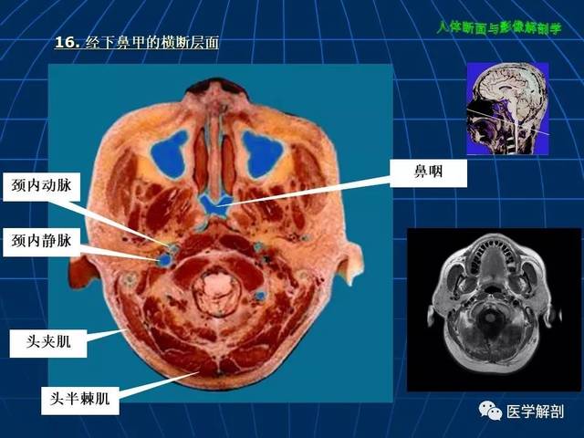 超赞!颅脑大体及磁共振断层解剖(轴位)