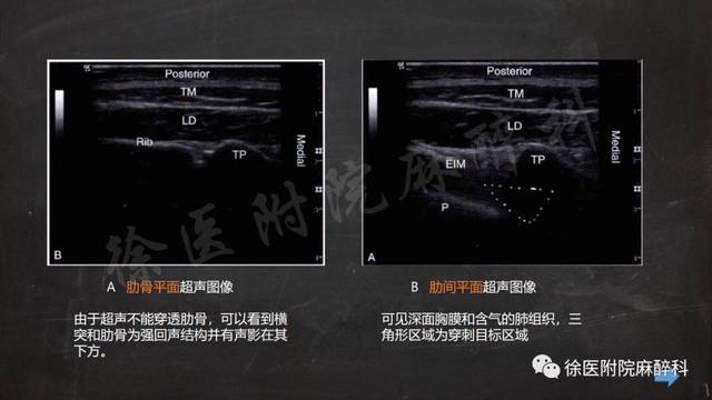 超声引导下胸椎旁神经阻滞的临床应用