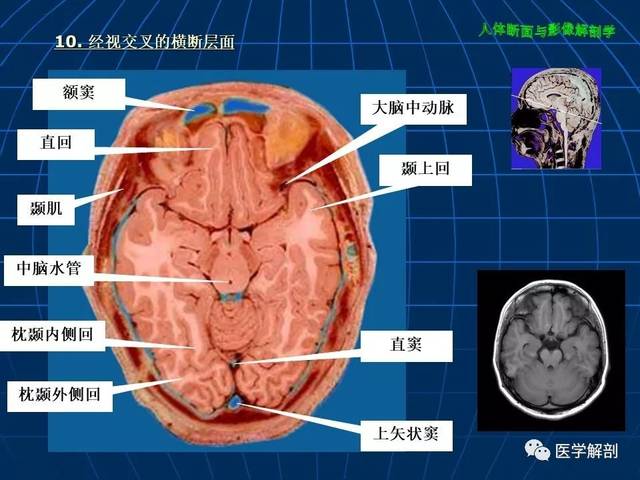 超赞!颅脑大体及磁共振断层解剖(轴位)