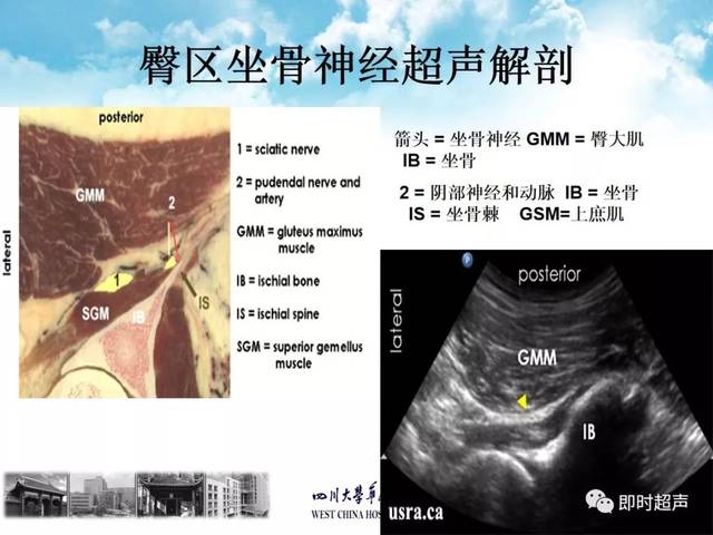 超声引导下股神经,坐骨神经阻滞
