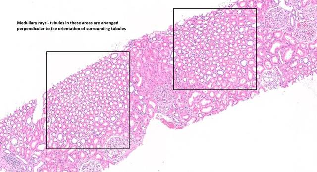 肾小管间质之皮质 | 肾活检导读