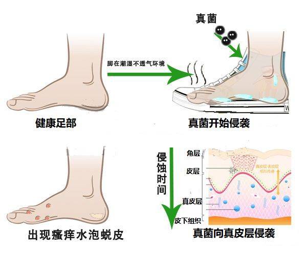 脚气≠脚气病